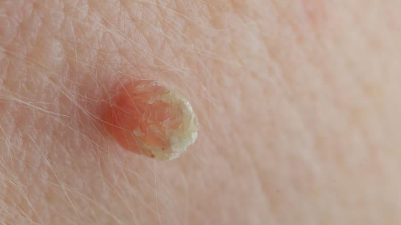 Close up image of a skin tag on a face.
