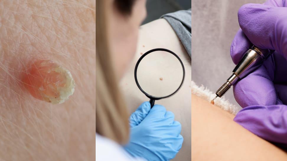 Three images of skin tags on a body being identified and excised.