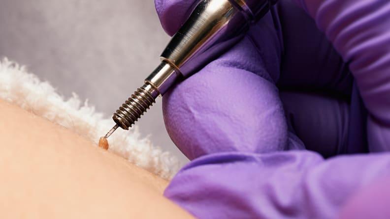 Heated Needle Tool Claims To Remove Skin Tags And Moles At Home, The Skin  Fix