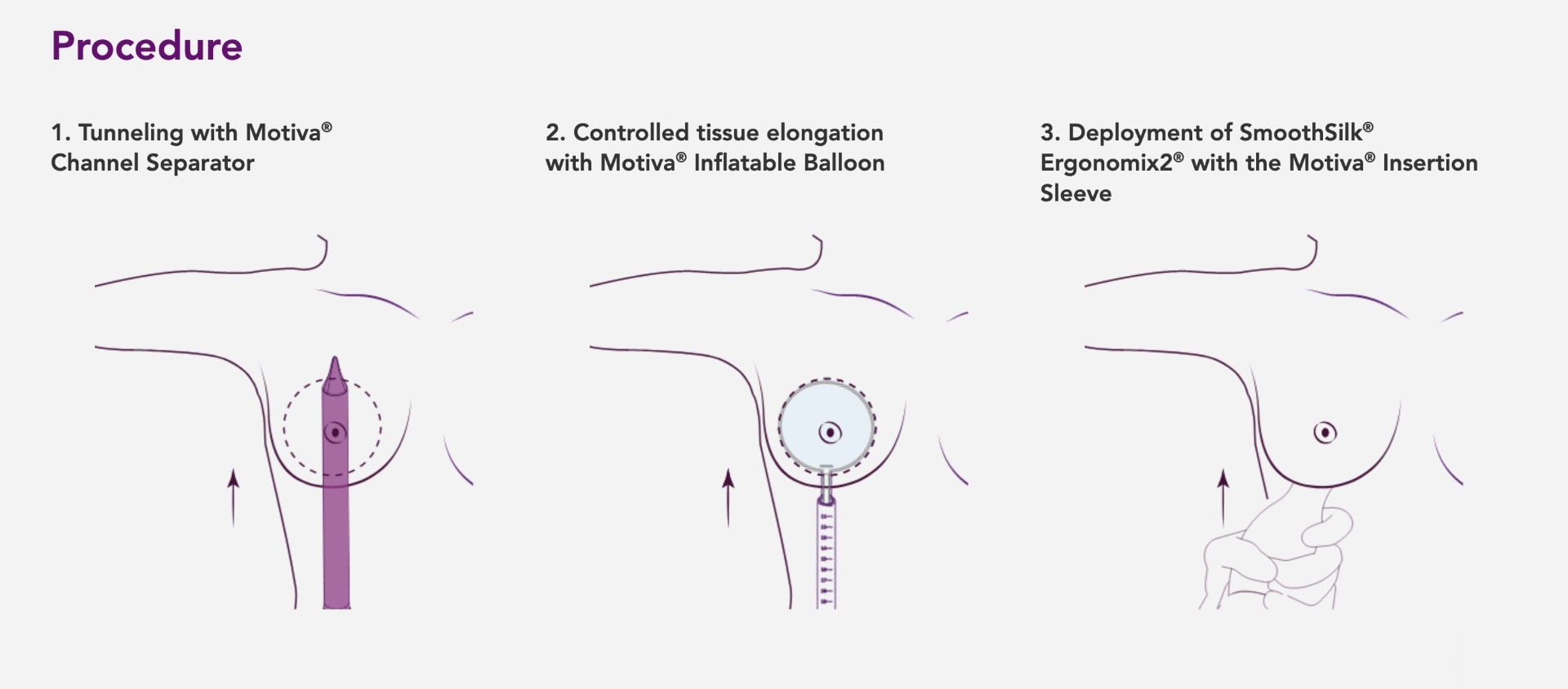 Miami Preservation Breast Augmentation model with brown hair