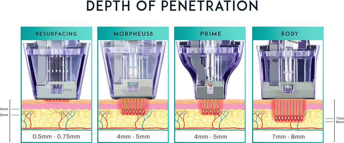 Morpheus8 Treatment Depths Graphic