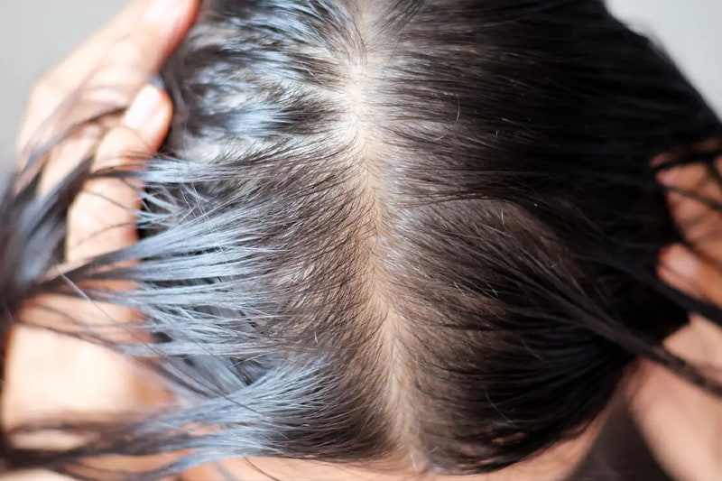 5 surprising things that make your hair fall out, from dry shampoo to PTSD