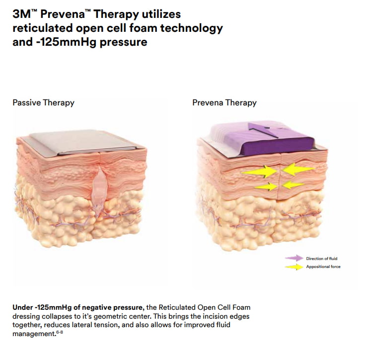 Prevena Incision Therapy Miami | Scar Therapy Miami | Dr. Z