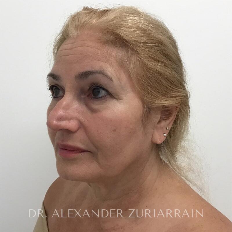 Face Before & After