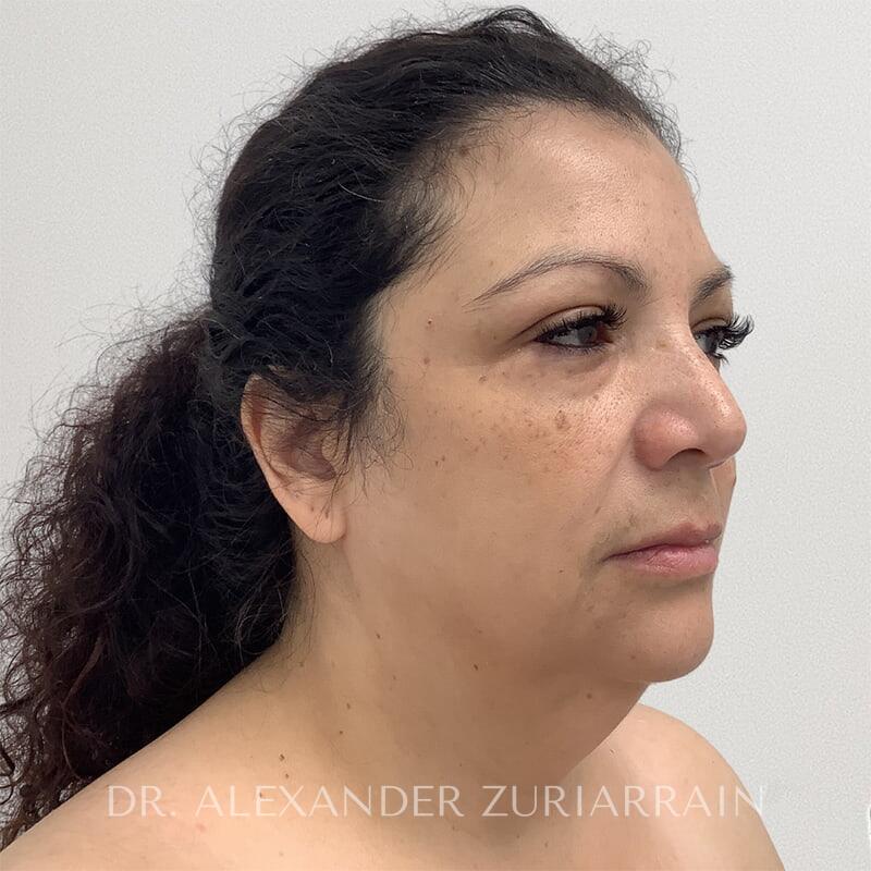Face Before & After