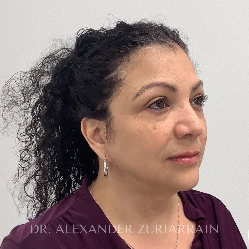 Face Before & After