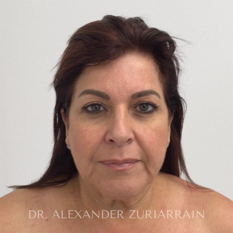 Face Before & After
