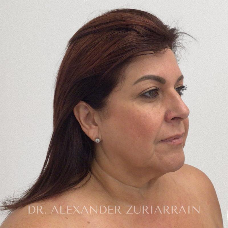 Face Before & After