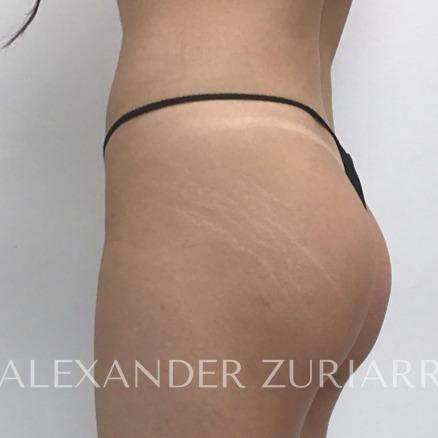Alloclae before & after photo