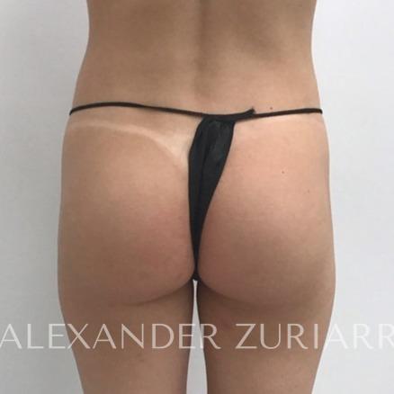 Alloclae before & after photo