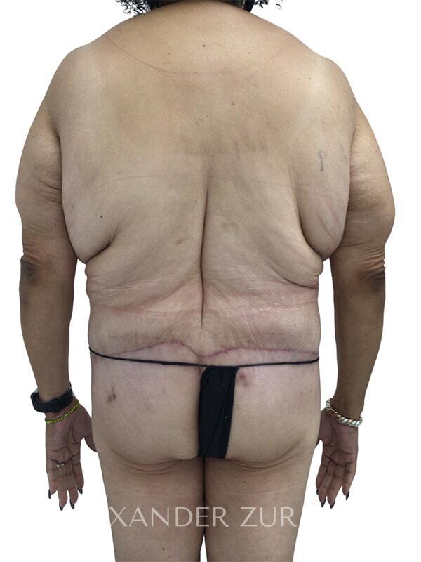 https://www.zuriplasticsurgery.com/assets/inc/watermark.php?img=/gallery/body/back-lift/02/01.jpg