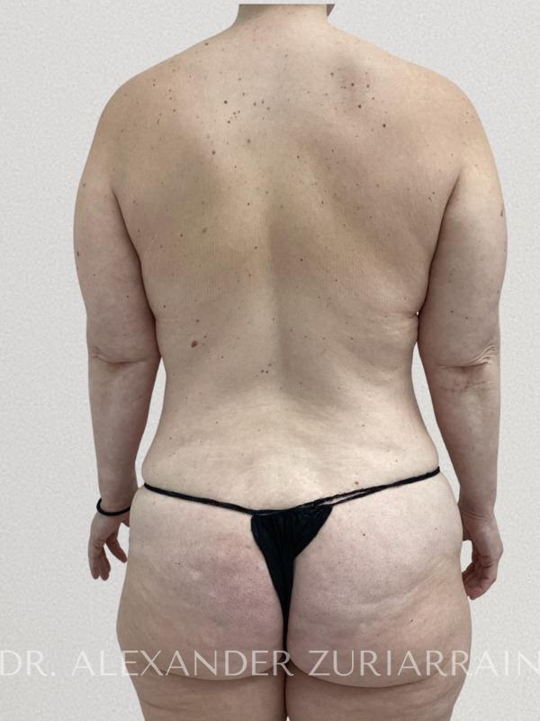 Back lift before & after photo