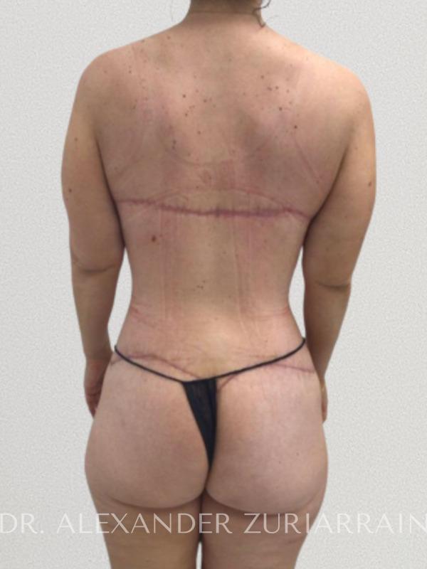 Back lift before & after photo