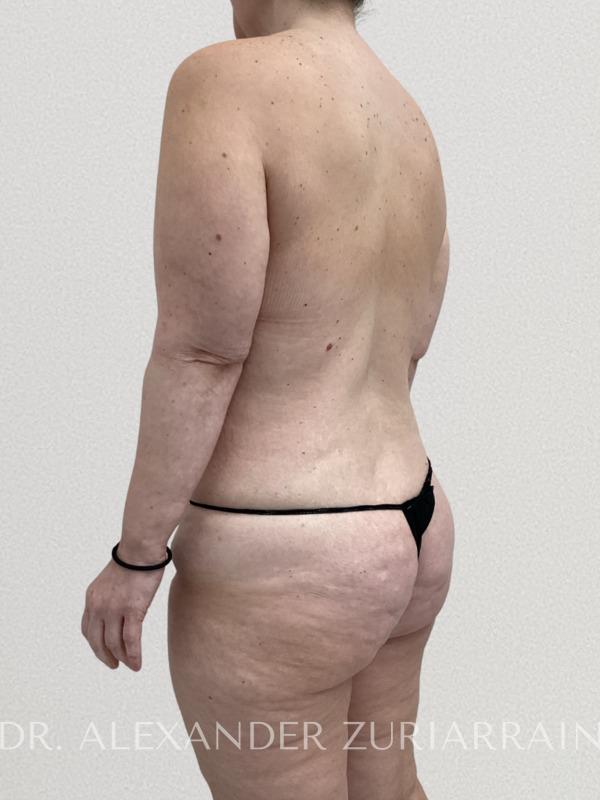 Back lift before & after photo