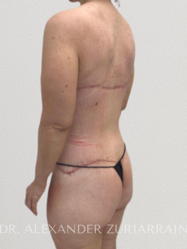 Back lift before & after photo