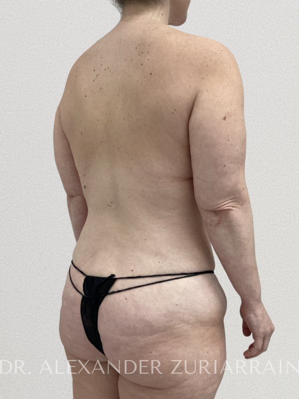 Back lift before & after photo