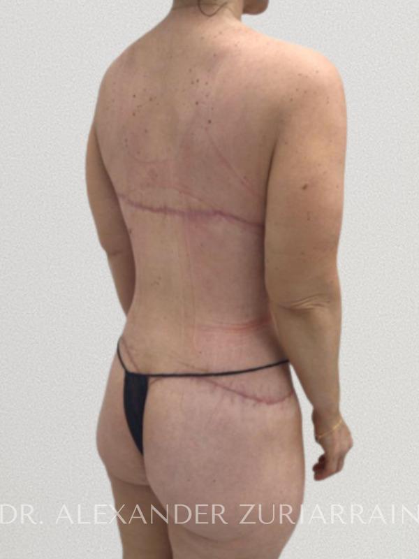 Back lift before & after photo