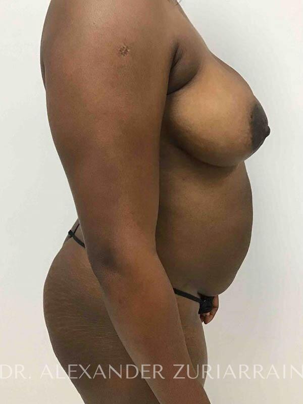 Brazilian butt lift before & after photo