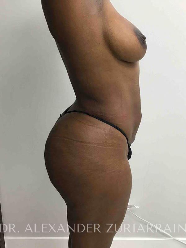 Brazilian butt lift before & after photo