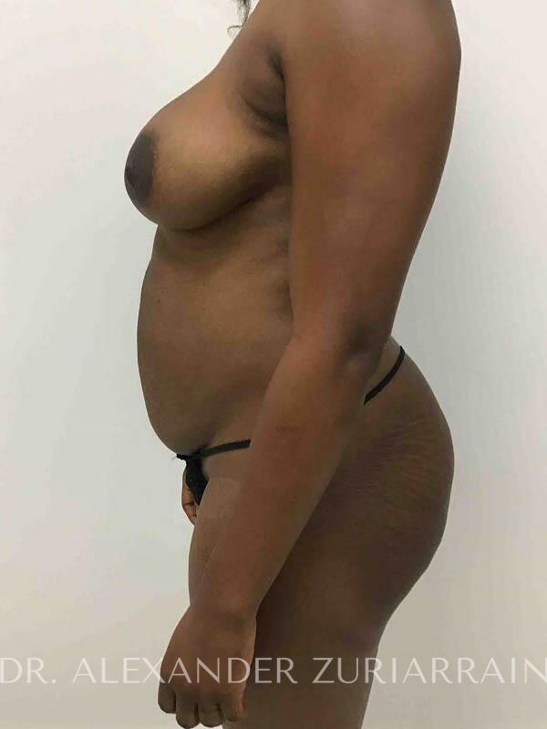 Brazilian butt lift before & after photo
