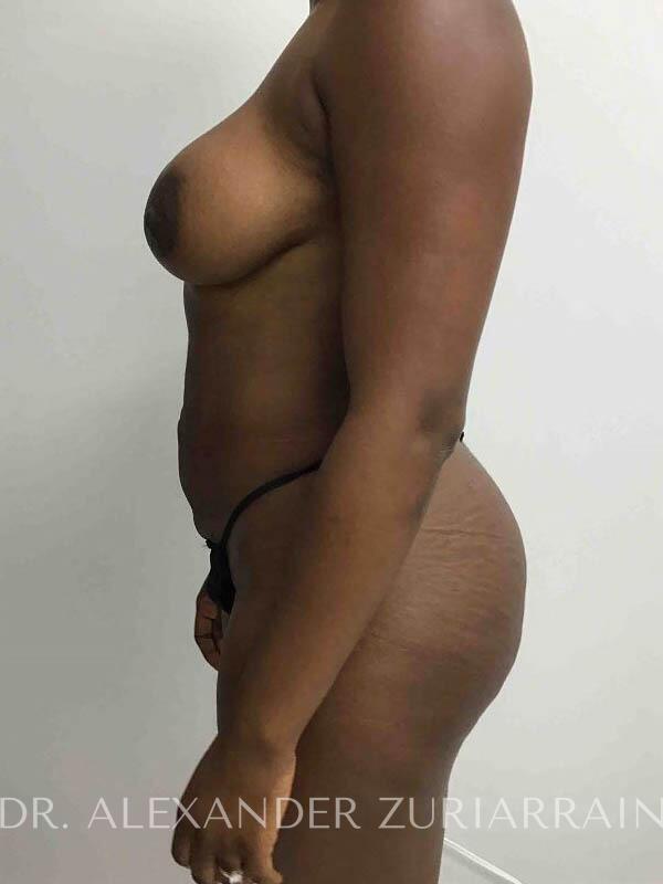 Brazilian butt lift before & after photo