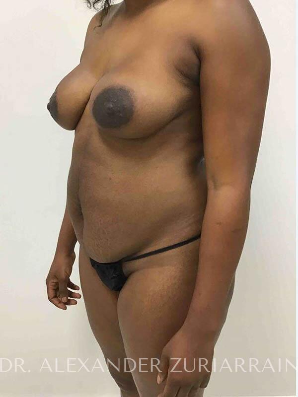Brazilian butt lift before & after photo