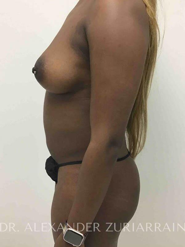 Brazilian butt lift before & after photo
