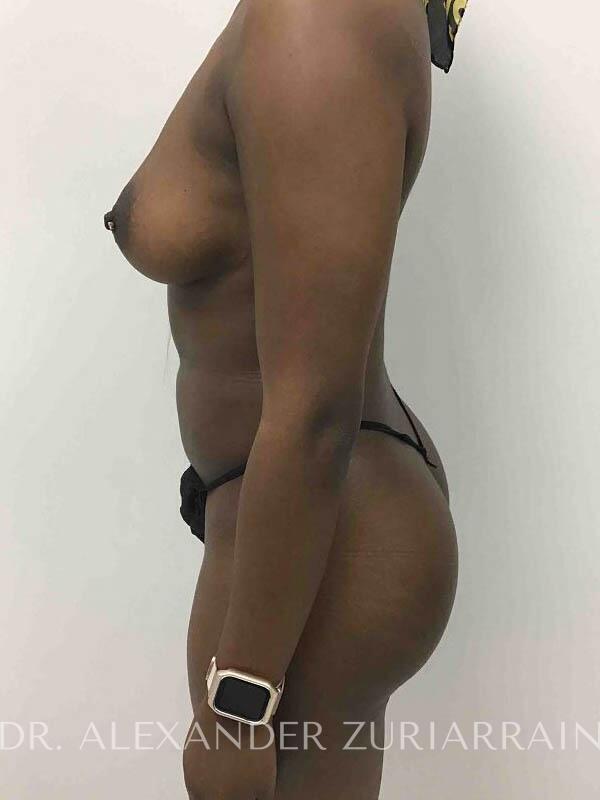 Brazilian butt lift before & after photo