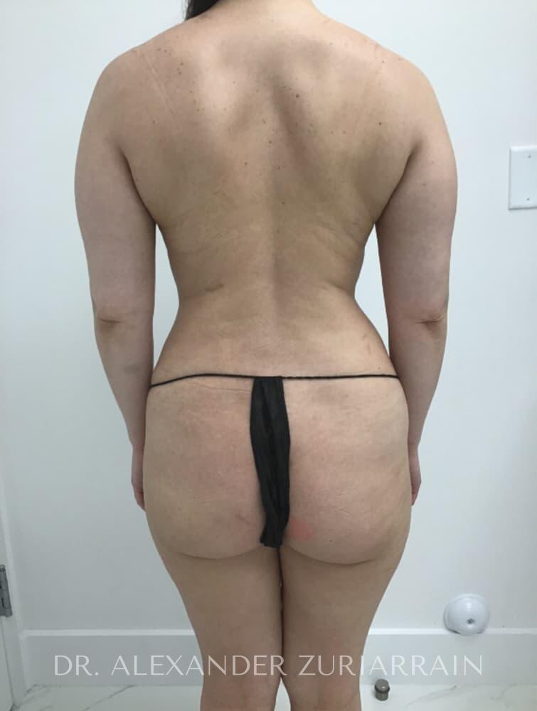 Brazilian butt lift before & after photo