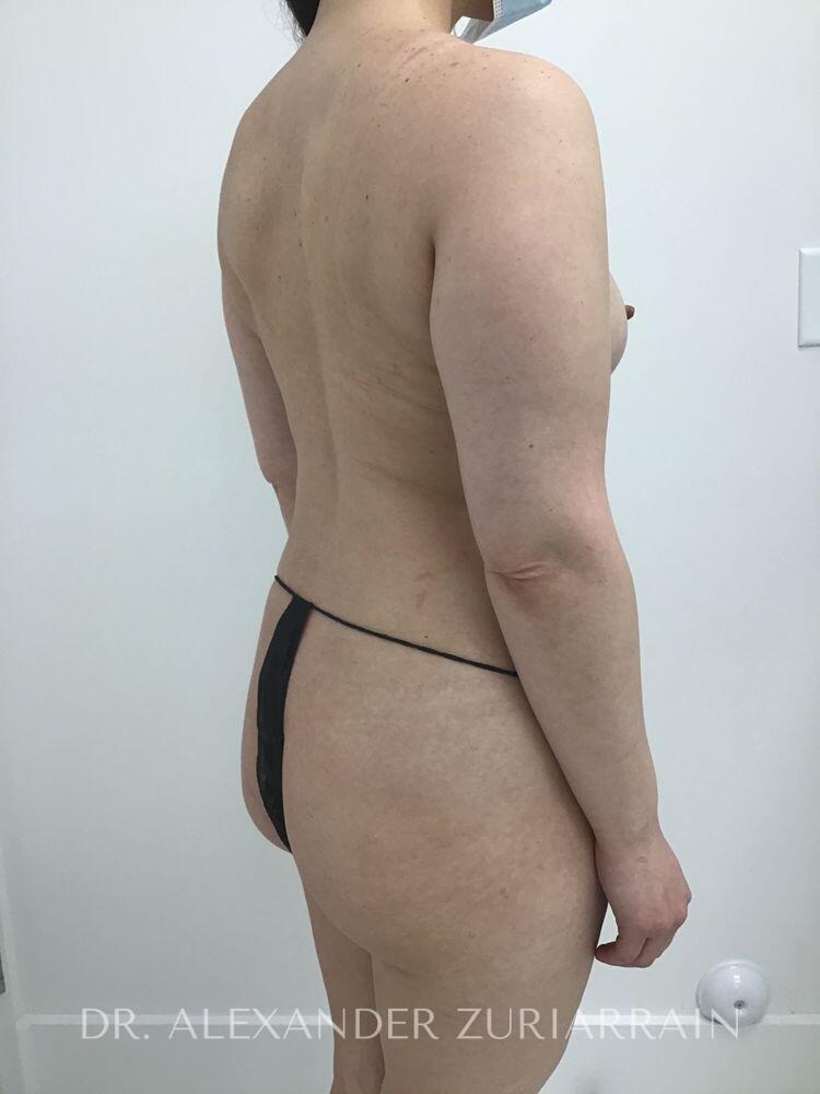 Brazilian butt lift before & after photo