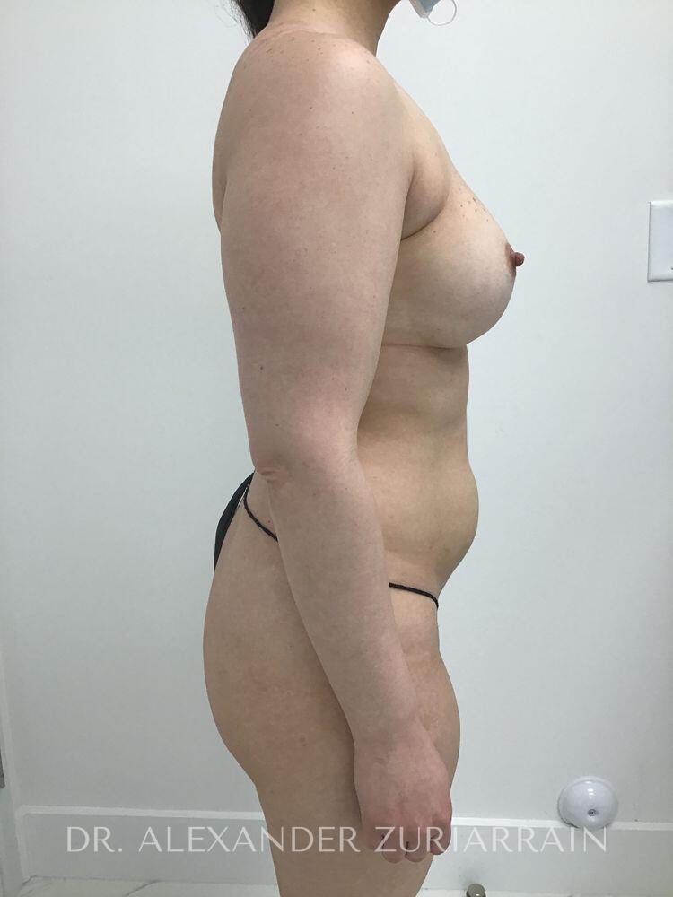 Brazilian butt lift before & after photo