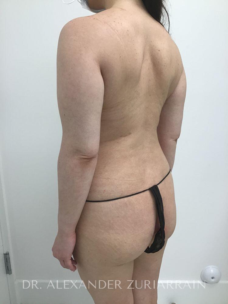 Brazilian butt lift before & after photo