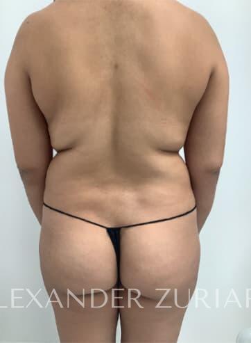 Brazilian butt lift before & after photo
