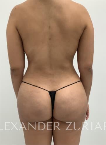 Brazilian butt lift before & after photo
