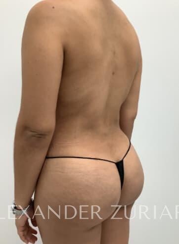 Brazilian butt lift before & after photo