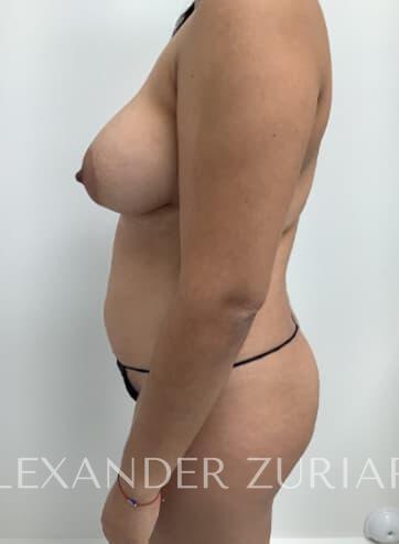 Brazilian butt lift before & after photo