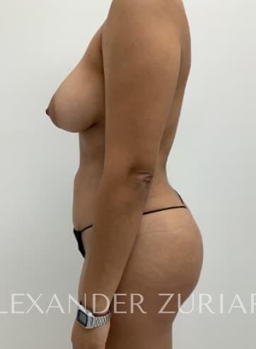 Brazilian butt lift before & after photo