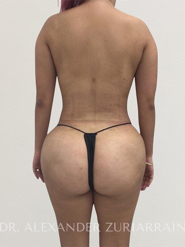 Brazilian butt lift before & after photo