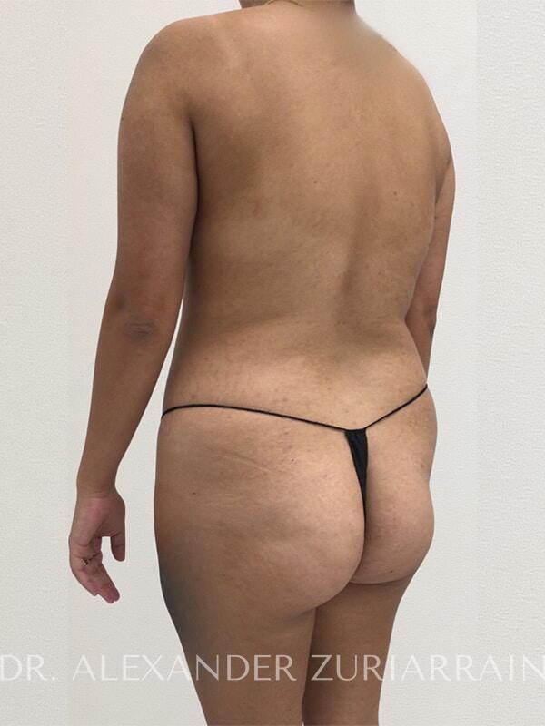 Brazilian butt lift before & after photo