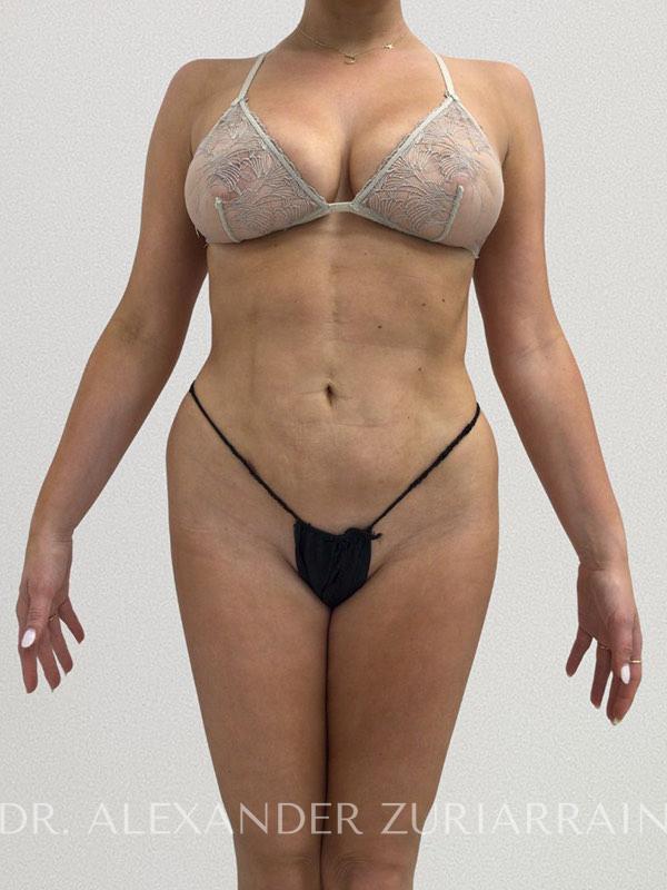 High definition liposuction before & after photo