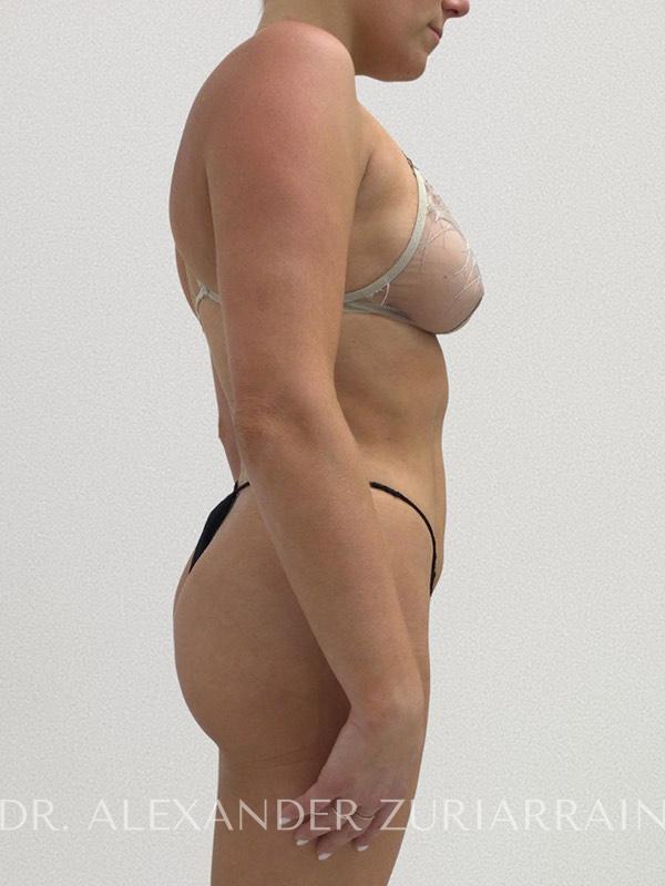 High definition liposuction before & after photo