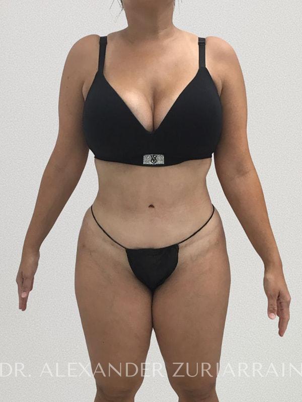 Lipo360 before & after photo
