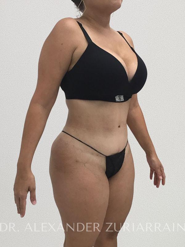 Lipo360 before & after photo