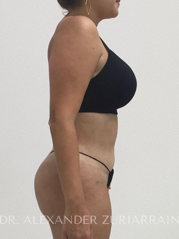 Lipo360 before & after photo