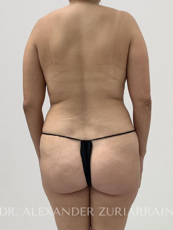 Lipo360 before & after photo