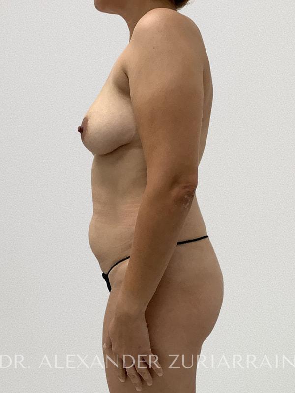 Lipo360 before & after photo