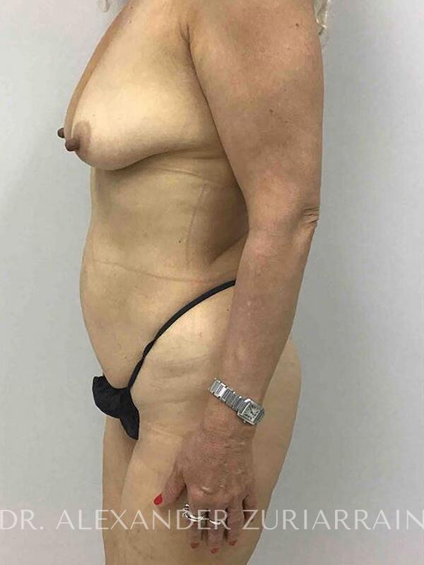 Lipo360 before & after photo
