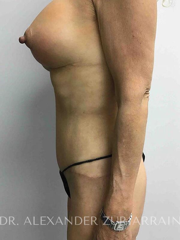 Lipo360 before & after photo