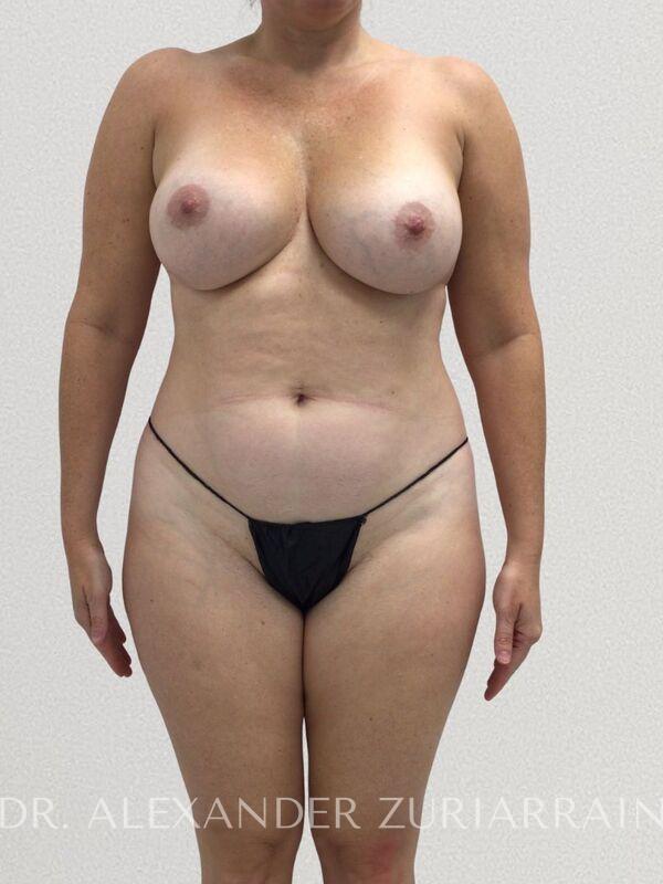 Lipo360 before & after photo