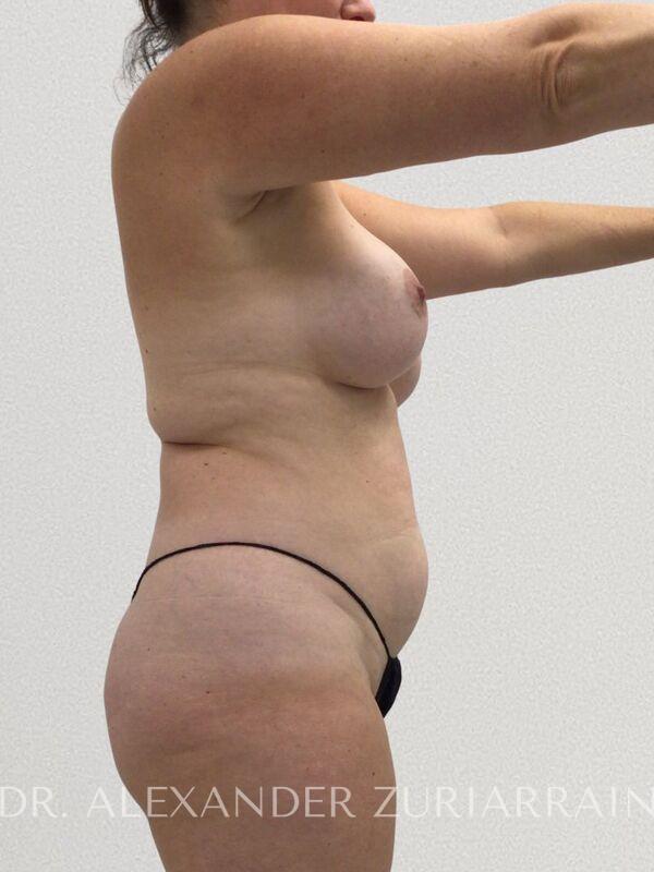 Lipo360 before & after photo